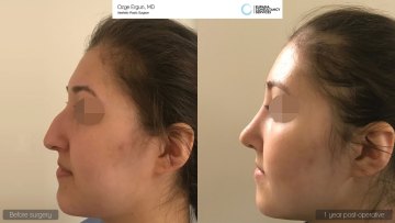 rhinoplasty