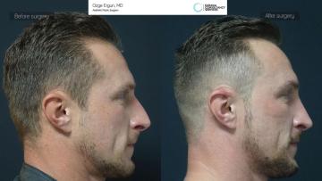 rhinoplasty