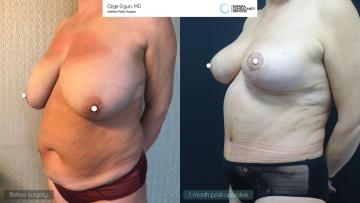 be_af_abl_tummytuck_breastlift_4