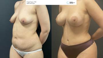 be_af_tummytuck_1_63417056