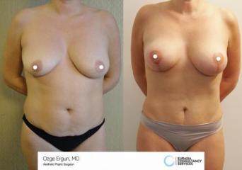 mastopexia__tummytuck_1_1