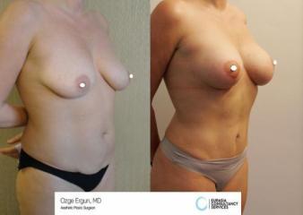 mastopexia__tummytuck_1_2