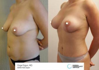 mastopexia__tummytuck_1_3