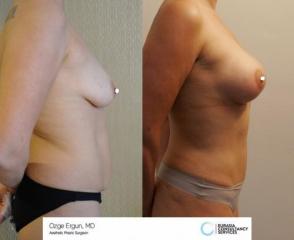 mastopexia__tummytuck_1_4