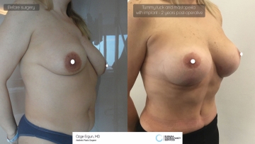 mastopexia__tummytuck_2_2-1