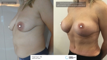 mastopexia__tummytuck_2_3-1