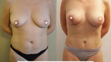 mastopexia__tummytuck_1_1