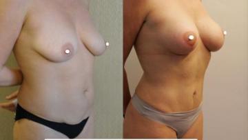 mastopexia__tummytuck_1_2