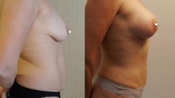 mastopexia__tummytuck_1_4