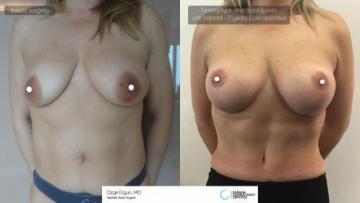 mastopexia__tummytuck_2_1