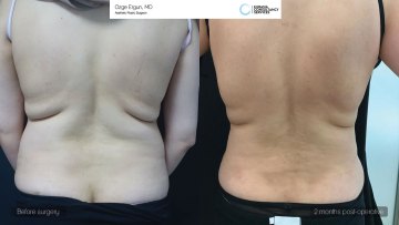 ba_af_sf_tummytuck_vaserlipo2